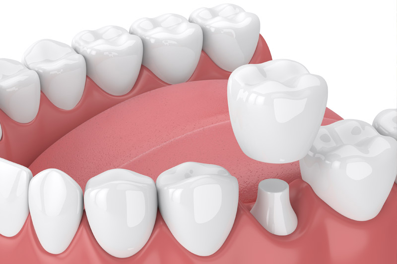 Dental Crowns in Yuba City