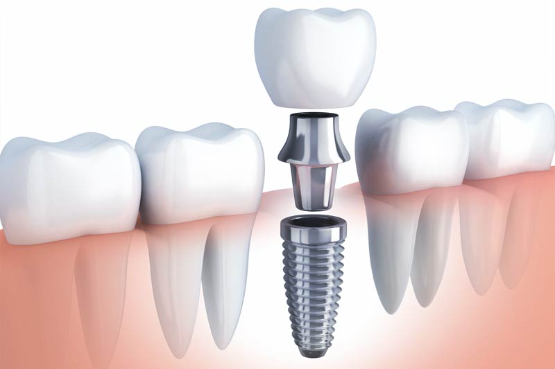 Implants Dentist in Yuba City