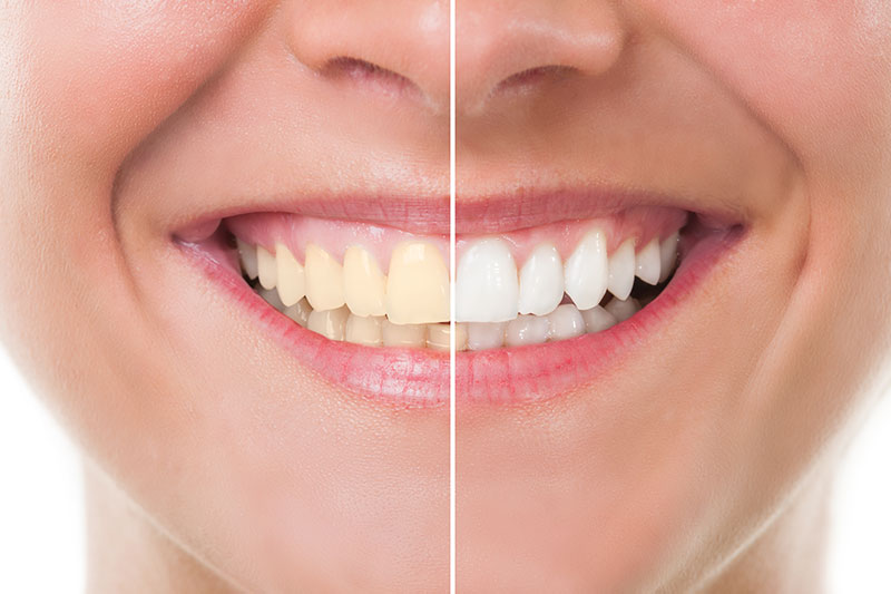 Teeth Whitening in Yuba City