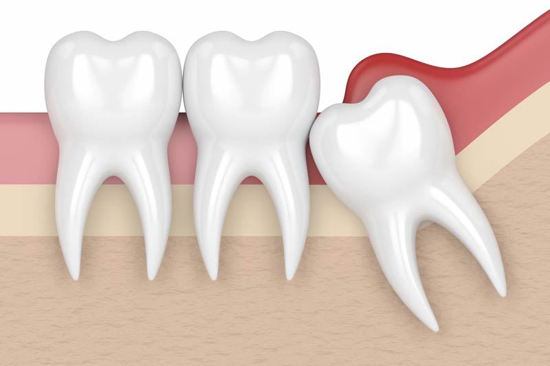 Wisdom Tooth Removal in Yuba City